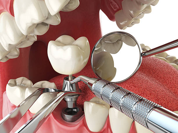 Best Emergency Wisdom Teeth Removal in Maltby, WA